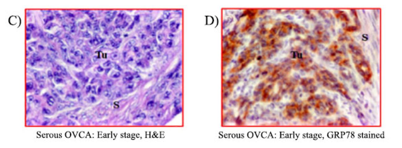 Left Image: C.) Serous OVCA: Early stage, H&amp;E. Tumor histology (hematoxylin &amp; eosin) showing a serious adenocarcinoma. D) Serous OVCA: Early stage, GRP78 stained. Strong staining for GRP78 expression by the tumor. Markings for Tu=Tumor and S=Stroma
