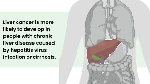 Liver cancer is more likely to develop in people with chronic liver disease caused by hepatitis virus infection or cirrhosis.