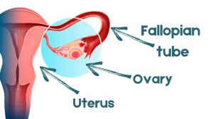 An illustration of the female reproductive system, displaying cancer growth in the ovary.