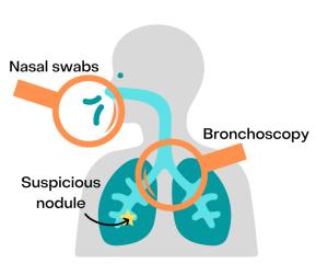 An illustration of a displaying a bronchoscopy, entering via nasal swabs to detect a suspicious nodule.