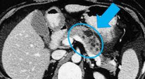 An MRI of a pancreas with cysts presenting.