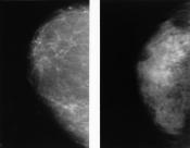 A side-by-side of two normal mammograms showing the difference between a dense breast (left) and a fatty breast (right).