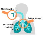 An illustration of a displaying a bronchoscopy, entering via nasal swabs to detect a suspicious nodule.