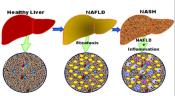 Illustration showing progression from normal liver to nonalcoholic steatohepatitis.